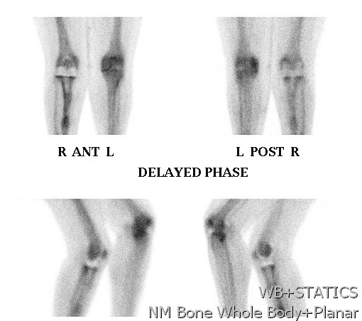 Bone Scan Loose TKR Increased Bone Phase